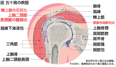 炎 周囲 肩 関節